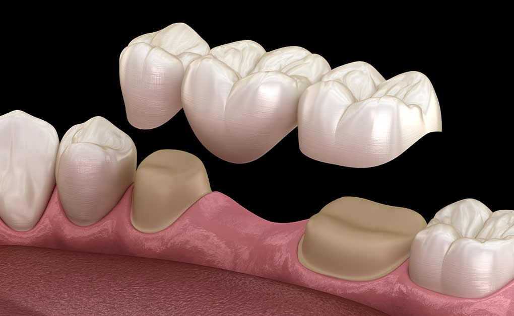 Punte dentară vs. implant dentar