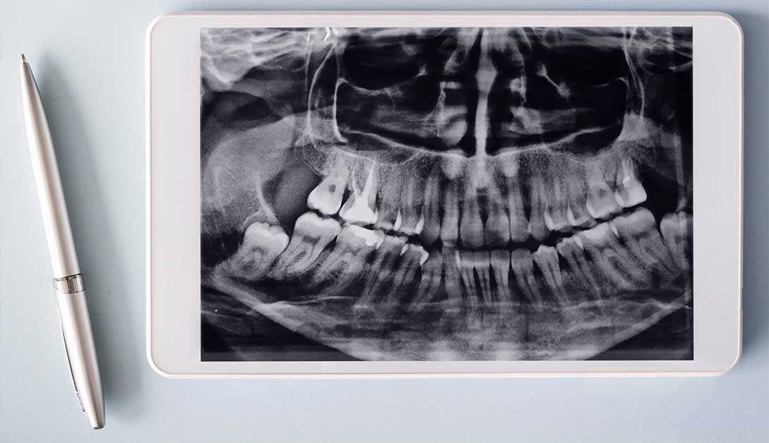 radiologie pentru implanturi dentare